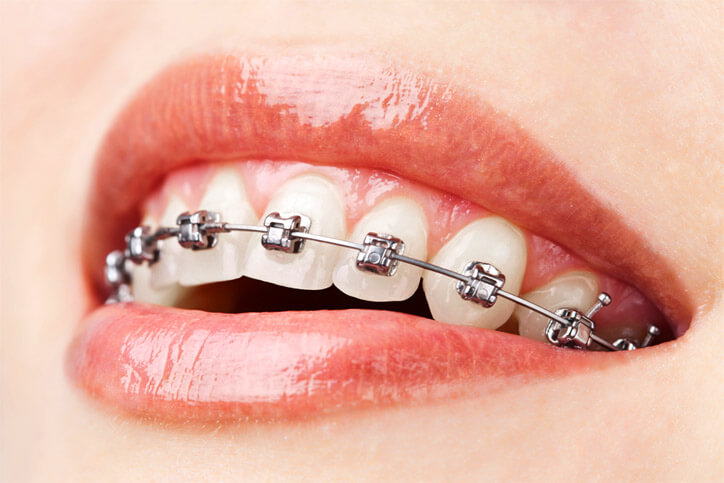Orthodontics (Braces Treatment)
