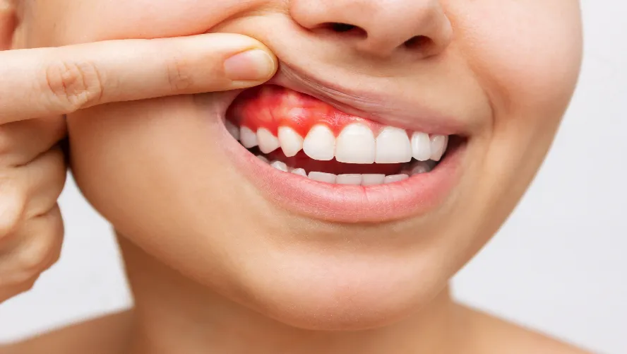 Gum Diseases (Periodontology) and Their Treatments
